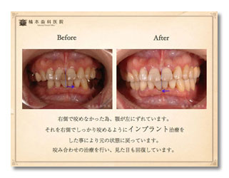 インプラント・咬合補綴の症例1