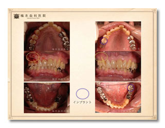 周病・咬合補綴6