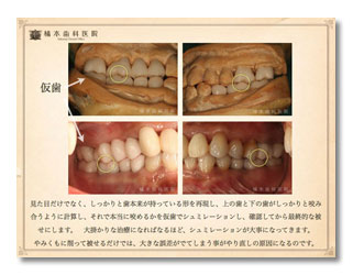仮歯の重要性2