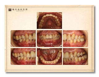 咬合補綴・歯周病・審美　仮歯でのシュミレーション1