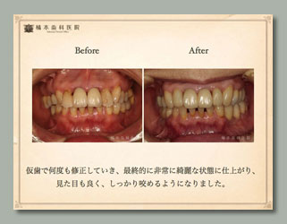 咬合補綴・歯周病・審美　仮歯でのシュミレーション4