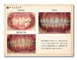 矯正治療、審美修復、歯周形成外科治療の症例（矯正治療は中西矯正歯科にて）