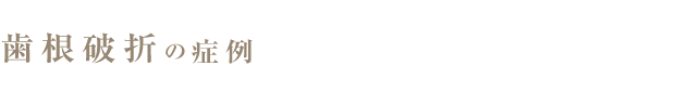 歯根破折